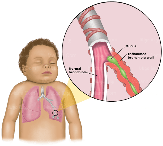 تعرف على " فيروس rsv " أعراضه وطرق الوقاية.... يسبب التهاب رئوي بين الأطفال !!! 1 الفيروس المخلوي التنفسي