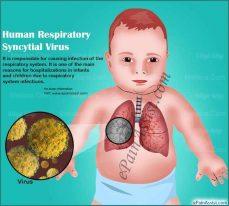 تعرف على " فيروس rsv " أعراضه وطرق الوقاية.... يسبب التهاب رئوي بين الأطفال !!! 3 فيروس rsv