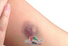 رؤية كدمات زرقاء في المنام