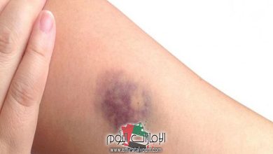 رؤية كدمات زرقاء في المنام