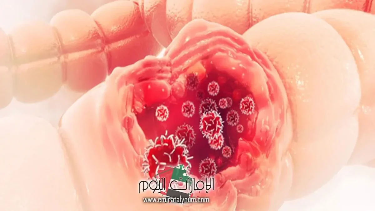 هل يعود سرطان القولون بعد استئصاله؟ 1 هل يعود سرطان القولون