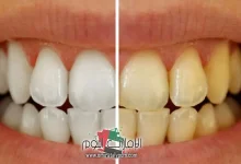 وصفة مجربة لتبييض الأسنان فى يوم واحد 4 وصفة لتبييض الأسنان