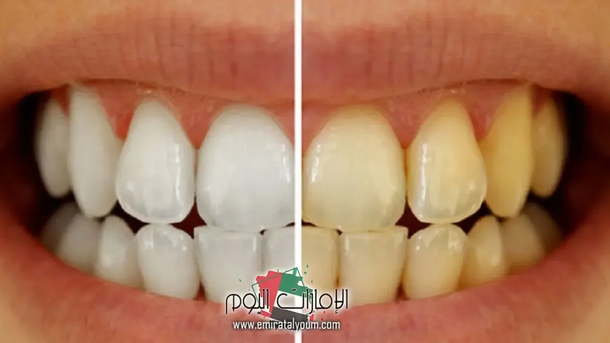 وصفة مجربة لتبييض الأسنان فى يوم واحد 1 وصفة لتبييض الأسنان